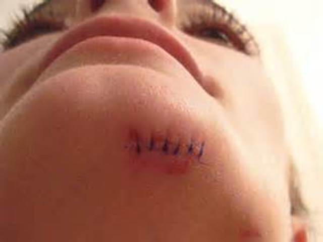 Had to get stiches on my chin