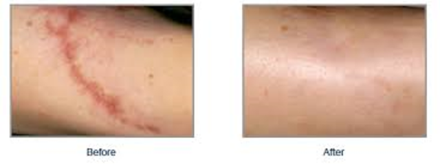 The Medical Benifits Of the Laser