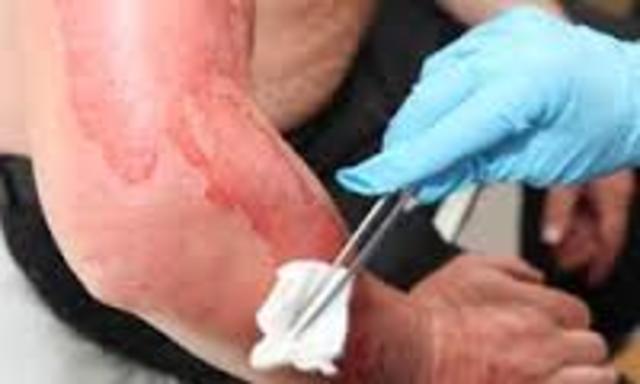 Hot Coffee Burn on my Foot