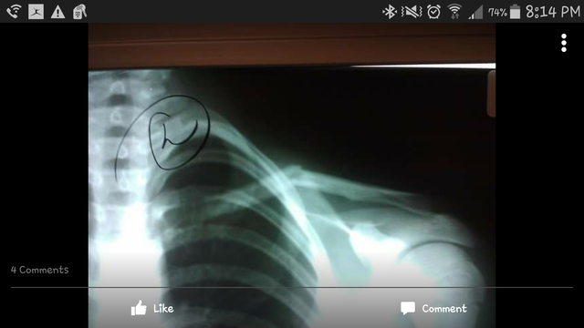 Broke collarbone