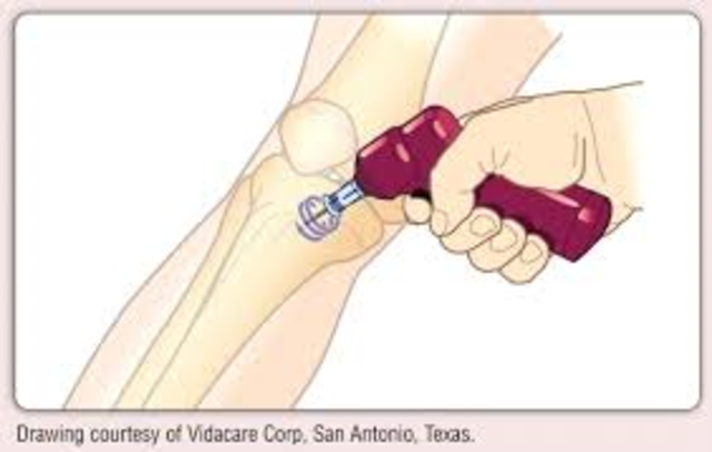 Intraosseous access was introduced to Pediatrics