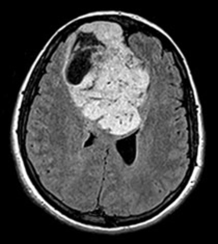 First brain tumor operation under local anaesthesia