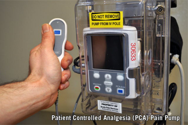 Patient Controlled Epidural Anesthesia or PCEA introduced