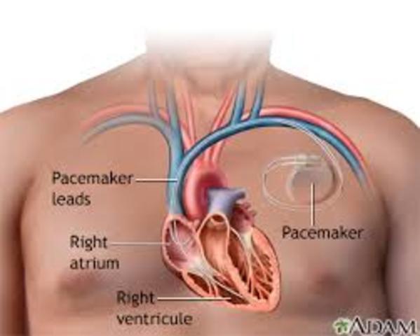 The first pacemaker