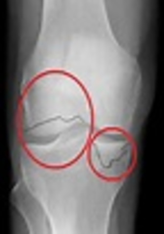 brother broke his knee cap