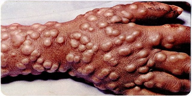 Smallpox