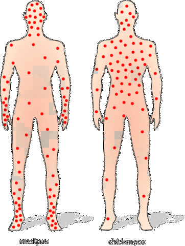 Rhazes discovered difference between small pox and measles