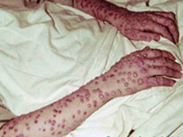 Rhazes discover difference between smallpox and measles