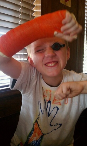 First time breaking a bone