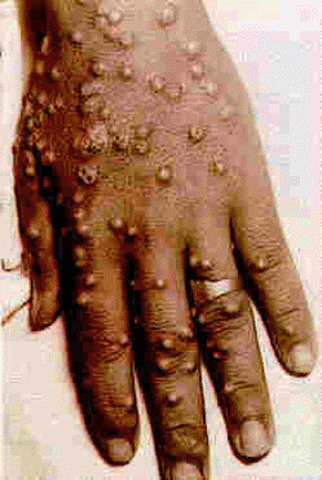 Rhazes discovered the difference between smallpox and measles.