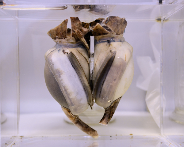 First FDA approved implanted AbioCor artifical heart placed in a paitent on June 24. Paitent died on August 23.