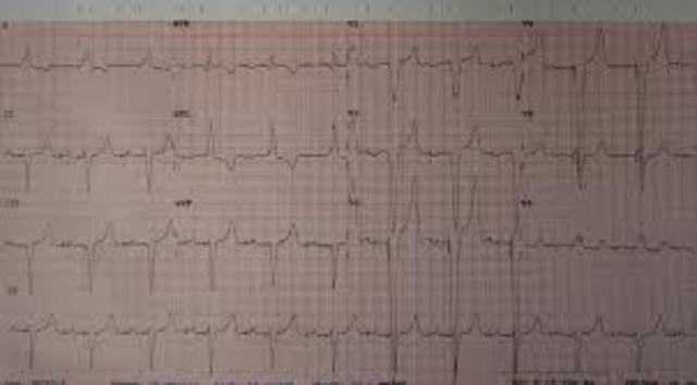 Paul Zoll developes the first cardiac pacemaker to control irregular heart beat