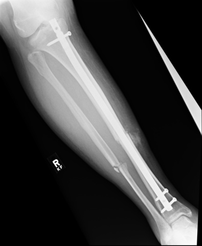 I broke my leg in sixth grade