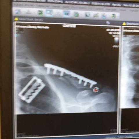 Oops...Ski accident :(