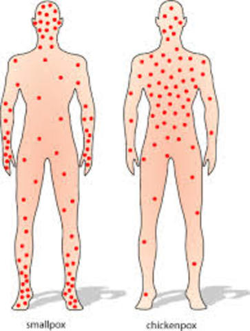 Rhazes discovered difference between small pox and measles