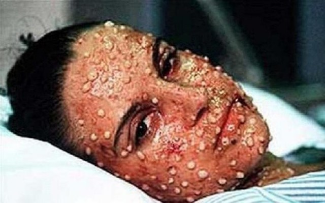 Bubonic plague hits San Francisco