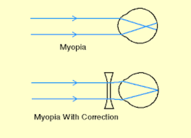 concave lenses used to treat myopia developed in intaly