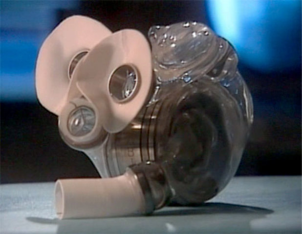 The first FDA approved implanted Abiocor artificial heart placed in a patient on June 24th and died August 23