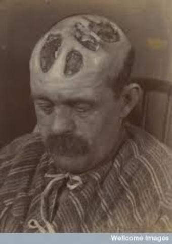 First Syphilis case in Europe