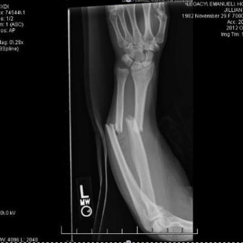 Broke my arm