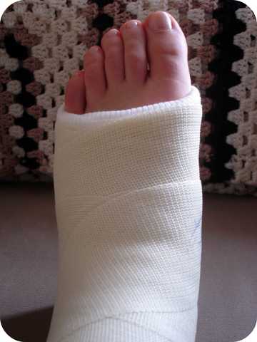 I broke my ancle