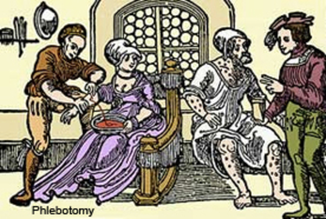 Barber-surgeons in England were restricted to bloodlettings, dental extractions, and hair care