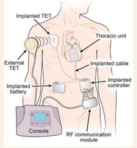 Third AbioCor Heart Transplant