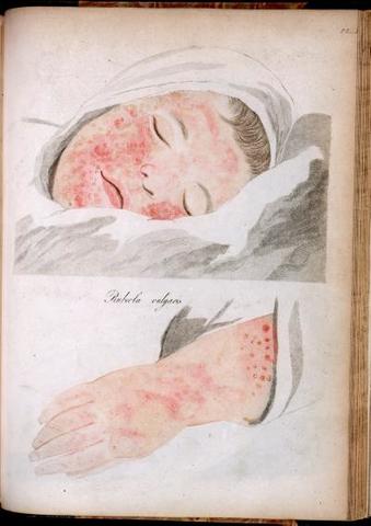 Rhazes discovered difference between smallpox and measles