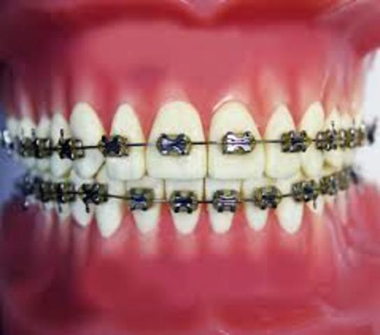 Got my braces on