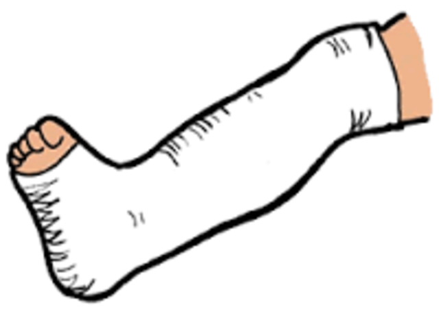 Broke my leg