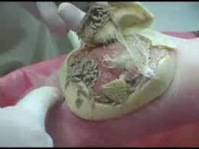 Steve thomas used maggots for infectious wound treatments