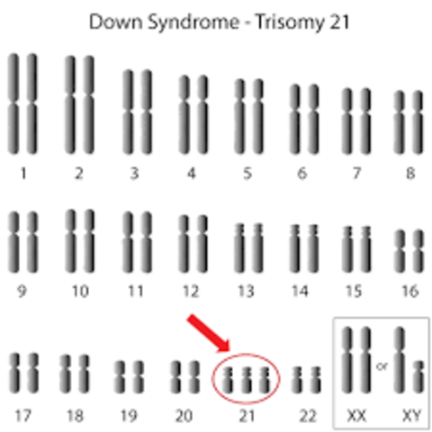 The Down Syndrome Mutation was Discovered