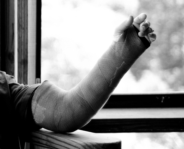 Broken Arm