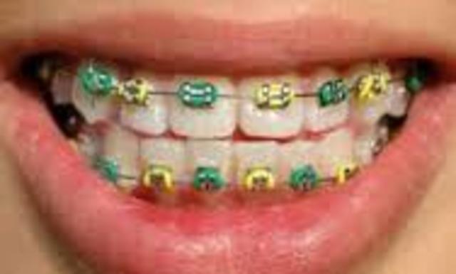 Got top braces on