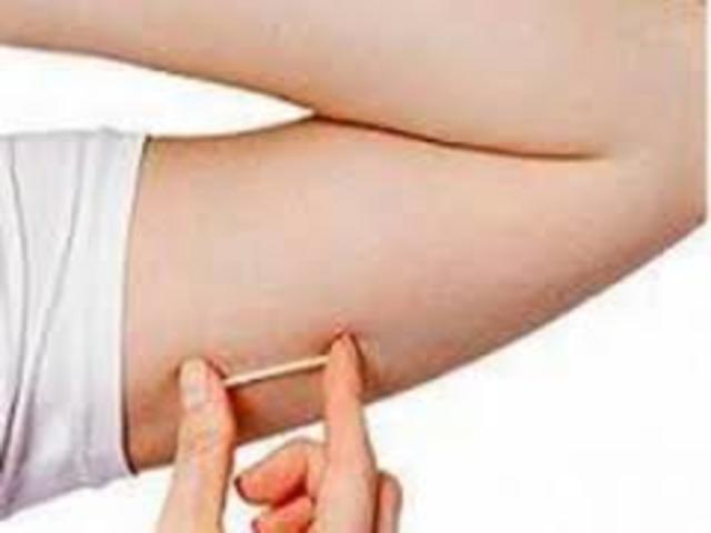 Anticonceptivo Subdermico (Chile)