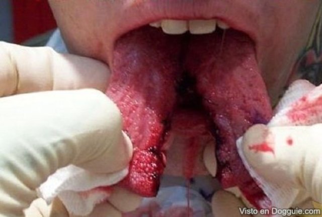 Me cai de un columpio.