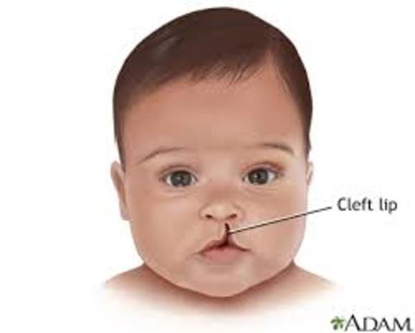 Birth defect: cleft lip or palate