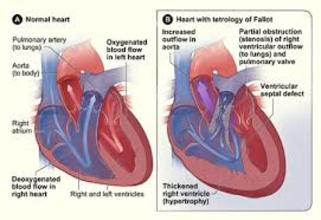 Birth defect: Heart defects