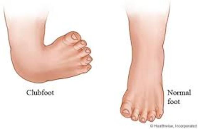 Birth defect: club foot