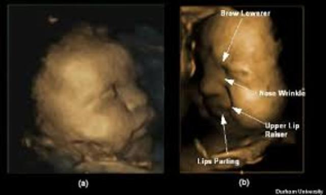 Birth defect: down syndrome