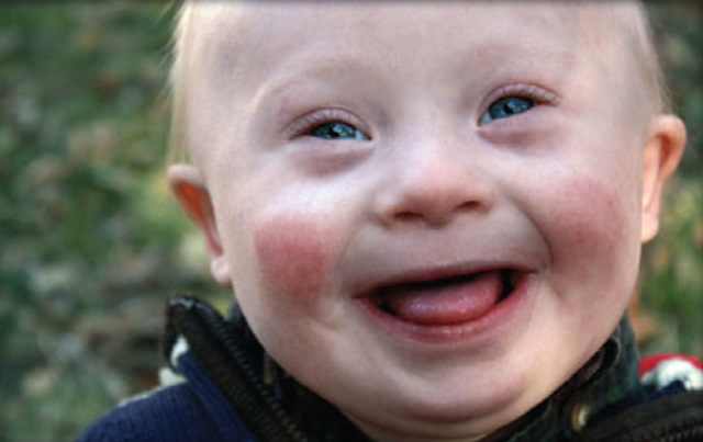 Down Syndrome