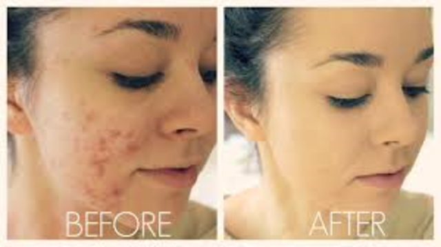 Acne Prone Skin Foundations