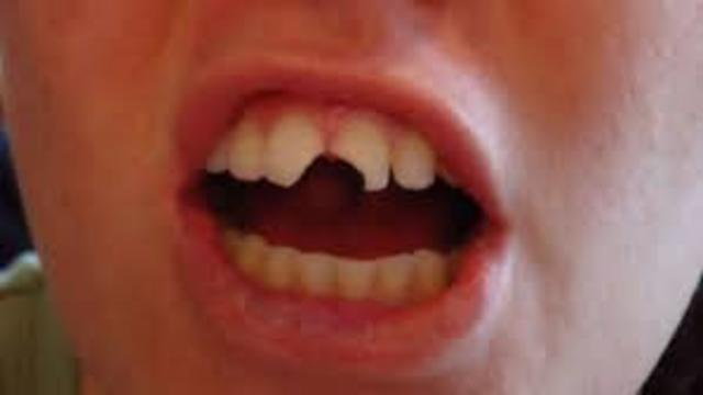 I broke my teeth