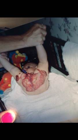 hopitalized for hemangioma