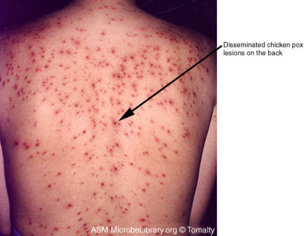 ChickenPox Discoverd