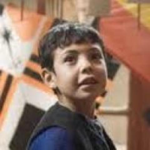 Hassan has surgery on his lip