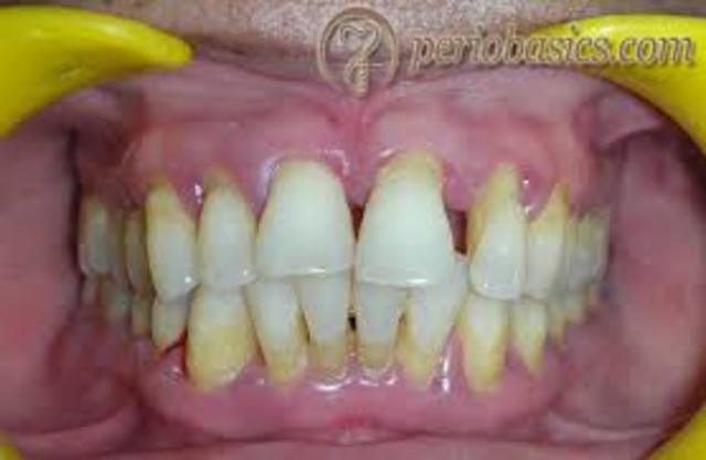 diseases seamen got while at sea