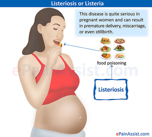 Listeriosis