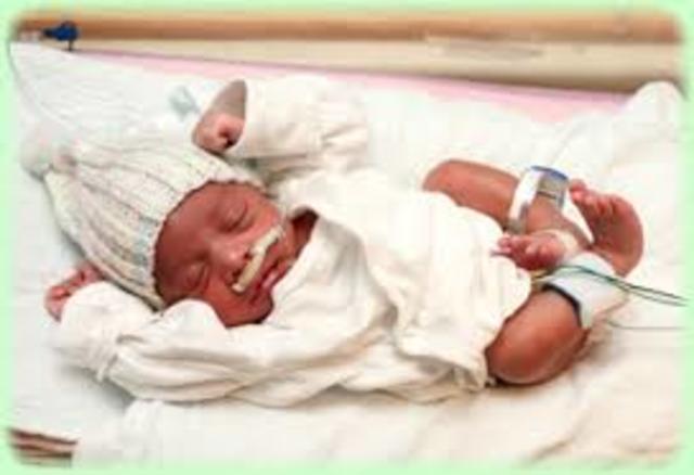 Link between birth and downsyndrome