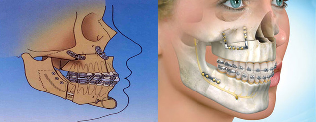 Jaw Surgery